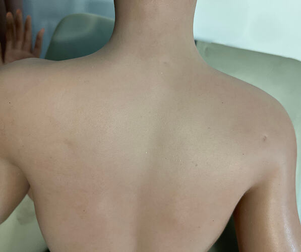 Pits and defects on back-背部有坑洞和瑕疵