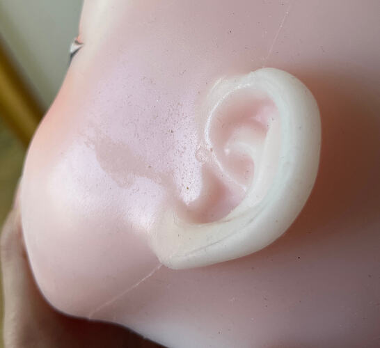 Pits around ears-耳边坑洼印记